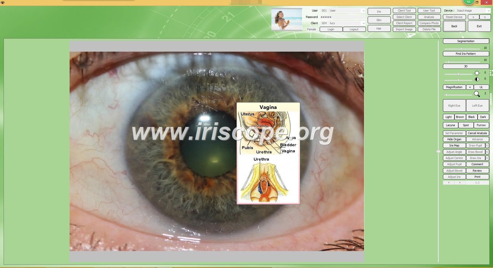 Sunshine Beeson Iridology